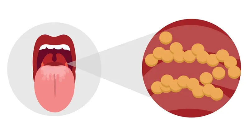 Ung thư lưỡi sống được boa lâu là mối quan tâm của nhiều người
