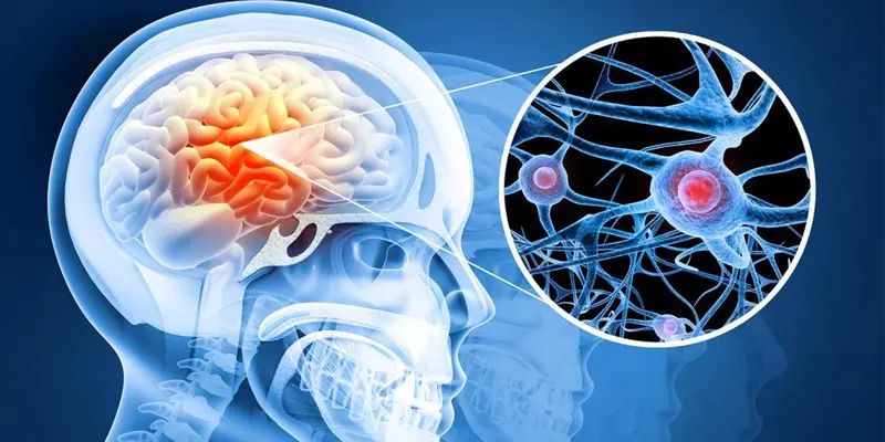 Ung thư phổi di căn não là tình trạng các tế bào ung thư từ phổi lan đến não và hình thành một hoặc nhiều khối u mới