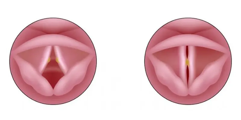 Ung thư thanh quản giai đoạn đầu là tình trạng các tế bào ác tính bắt đầu hình thành tại thanh quản