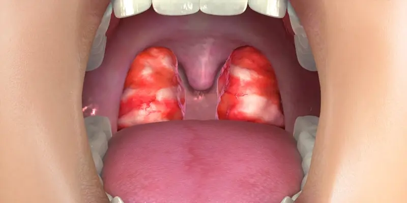 Bệnh ung thư vòm họng có di truyền không