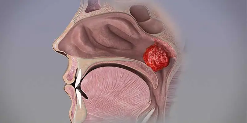 Ung thư vòm họng thường gặp ở độ tuổi nào