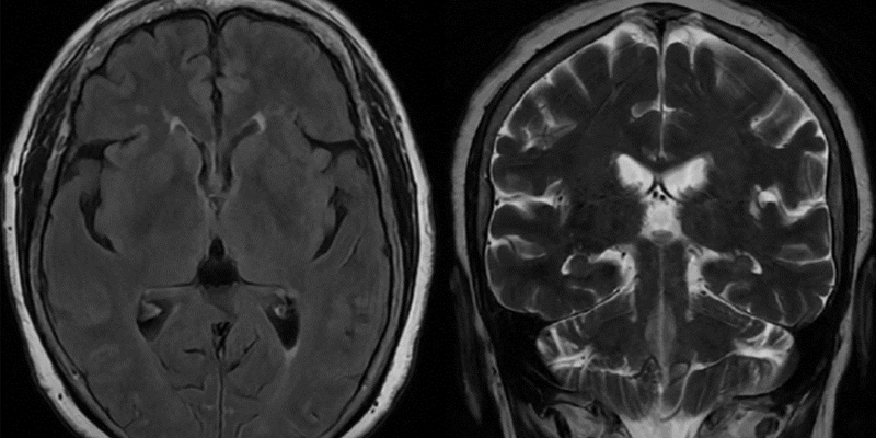 Chụp Ct để bác sỉ xác định được vị trí khối u của ung thư não