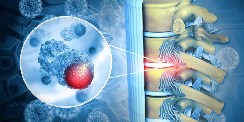 Định nghĩa ung thư tủy sống 