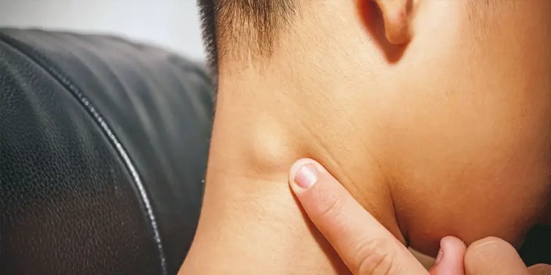 Nổi hạch vùng cổ hoặc góc hàm là biểu hiện của ung thư vòm họng giai đoạn 2