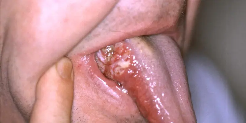 Ung thư lưỡi là bệnh ung thư phổ biến trong vùng miệng