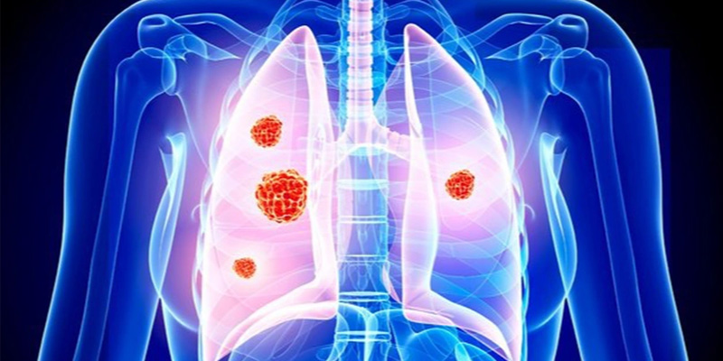 các loại ung thư não di căn trong đó có ung thư phổi