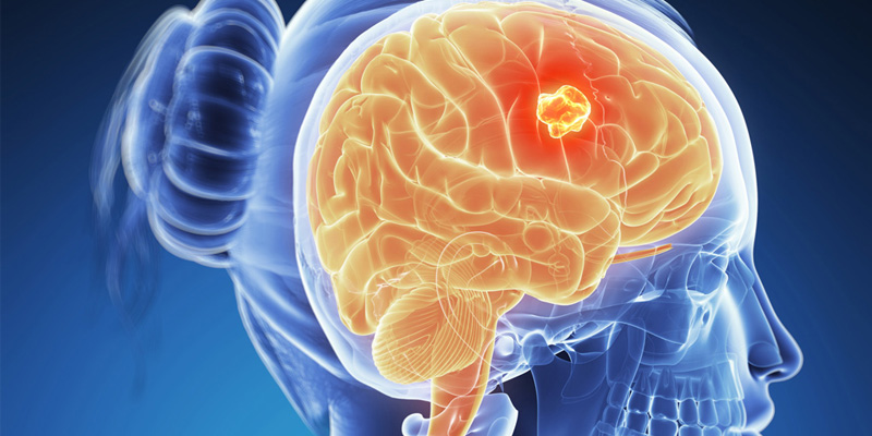 Ung thư não khiến người bệnh phải đối diện với nhiều biên chứng nguy hiểm
