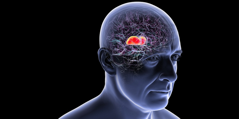 Ung thư não là bệnh lý nguy hiểm ảnh hưởng đến sức khỏe