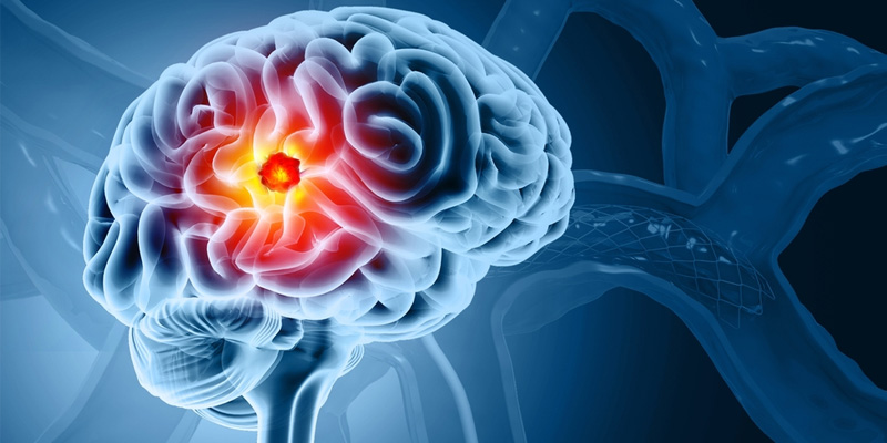 Ung thư não là bệnh lý nguy hiểm