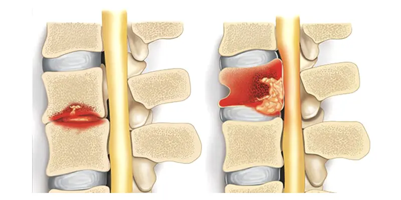 Ung thư tủy sống là một căn bệnh nguy hiểm