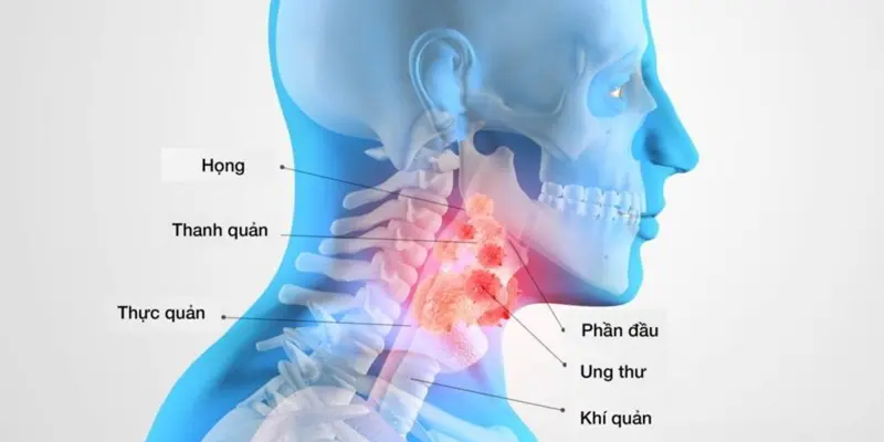 Ung thư vòm họng là khối u ác tính ở vòm họng