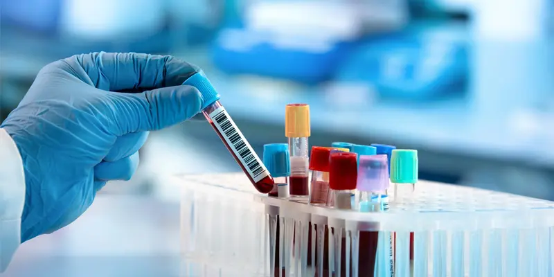 Xét nghiệm máu là bước đầu tiên cần thực hiện