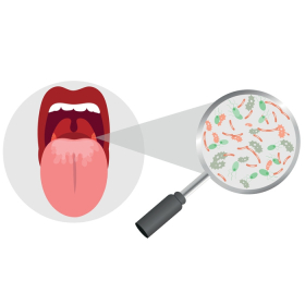 Ung thư lưỡi là gì? Triệu chứng, nguyên nhân và hướng điều trị